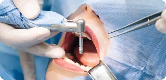 Хирургия зубов